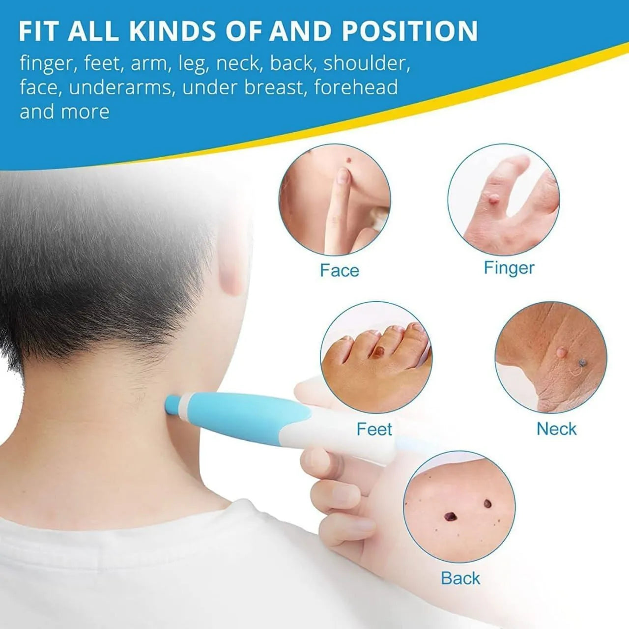 Auto Skin Tag Remover Kit