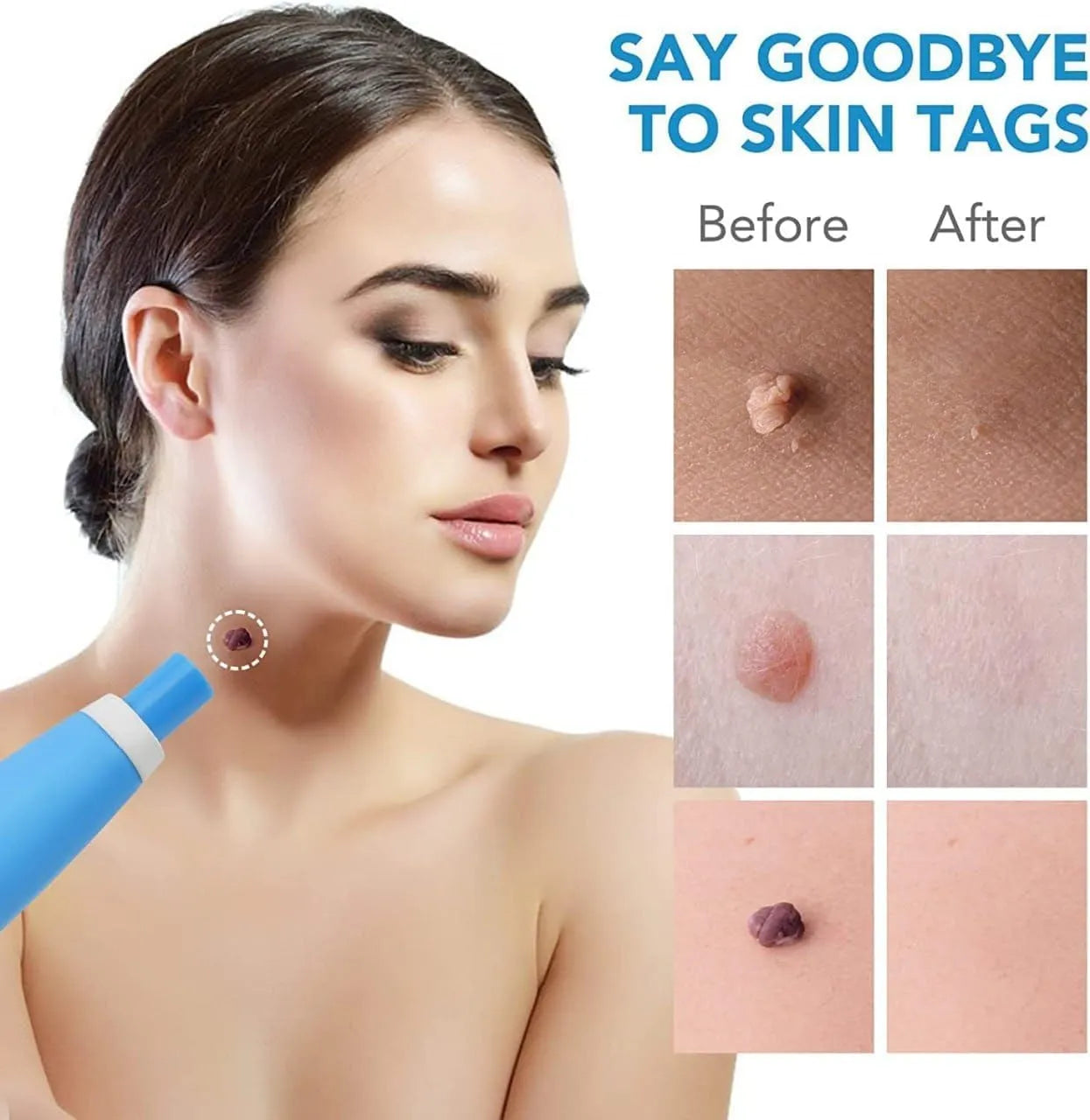 Auto Skin Tag Remover Kit