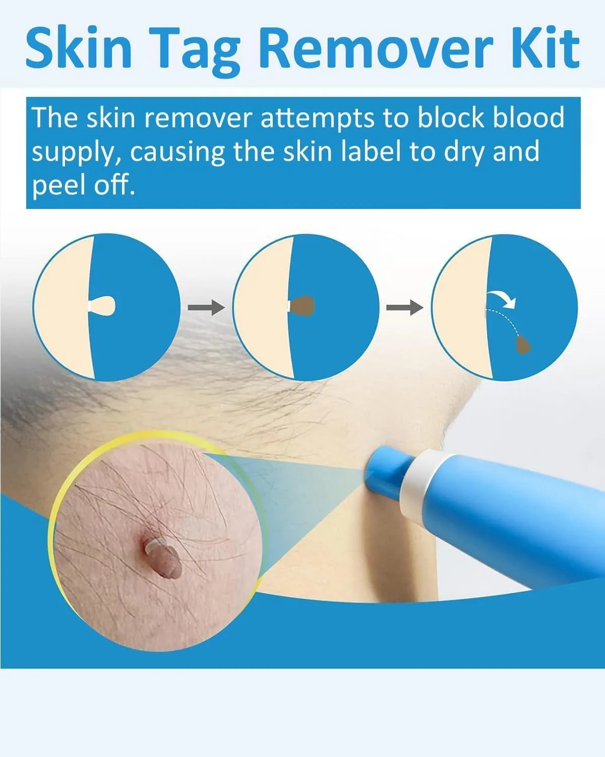 Auto Skin Tag Remover Kit