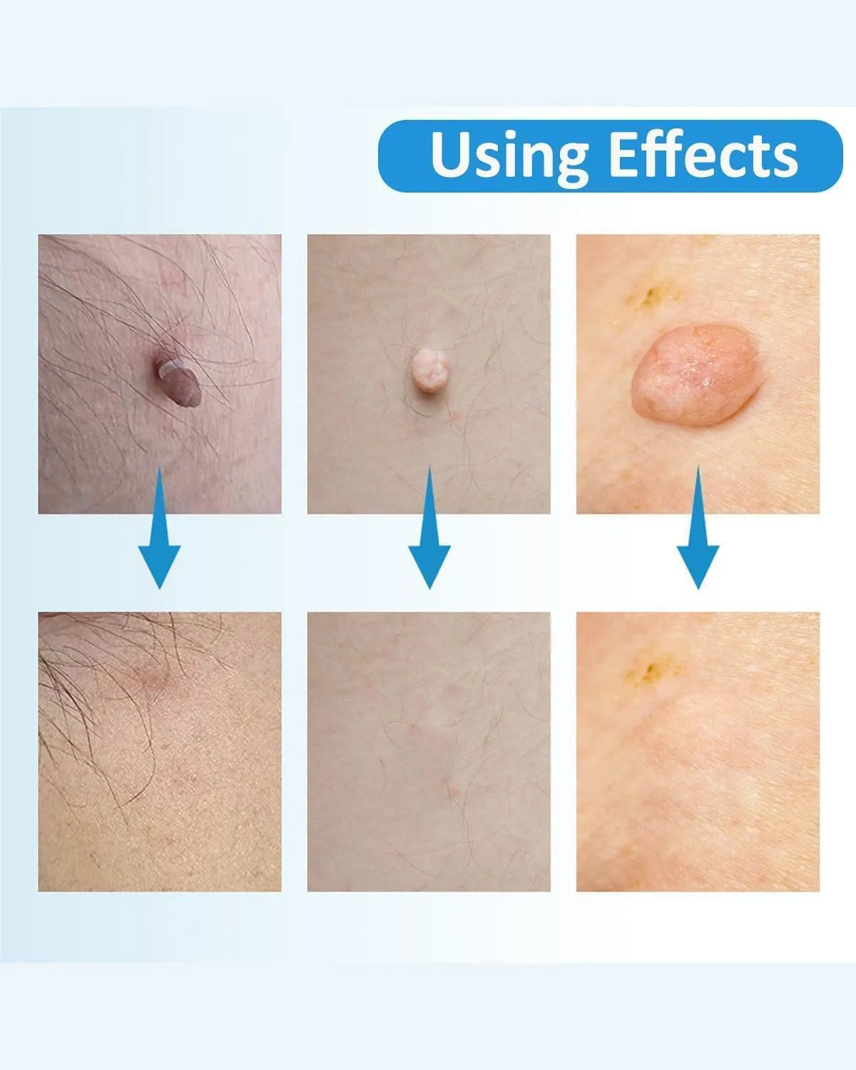 Auto Skin Tag Remover Kit